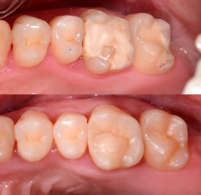 Molar con caries detectada en radiografía 100% digital